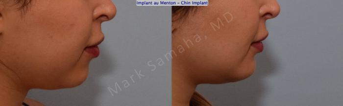 Before & After Augmentation du menton / Chin Augmentation Case 133 View #4 View in Montreal, QC