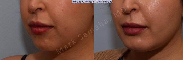 Before & After Augmentation du menton / Chin Augmentation Case 133 View #5 View in Montreal, QC