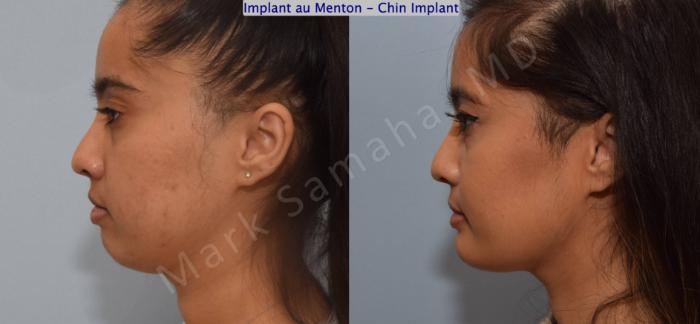 Before & After Augmentation du menton / Chin Augmentation Case 134 View #1 View in Montreal, QC