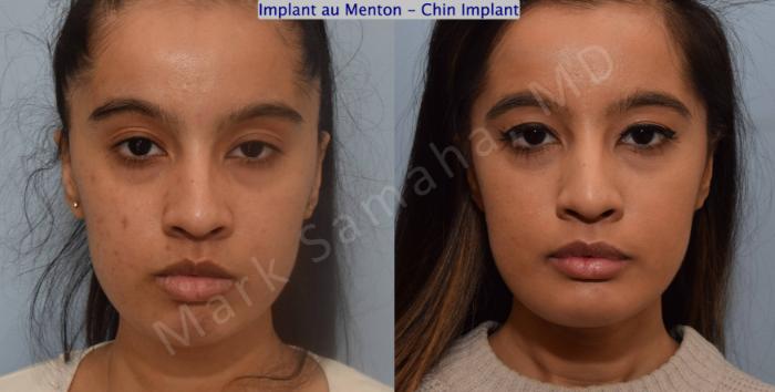 Before & After Augmentation du menton / Chin Augmentation Case 134 View #2 View in Montreal, QC