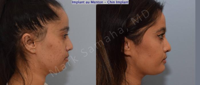 Before & After Augmentation du menton / Chin Augmentation Case 134 View #3 View in Mount Royal, QC
