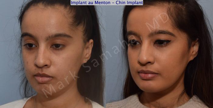 Before & After Augmentation du menton / Chin Augmentation Case 134 View #4 View in Montreal, QC