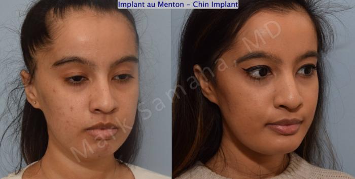 Before & After Augmentation du menton / Chin Augmentation Case 134 View #5 View in Montreal, QC