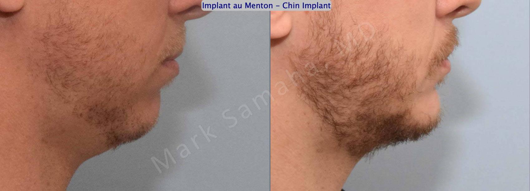 Before & After Augmentation du menton / Chin Augmentation Case 135 View #1 View in Montreal, QC