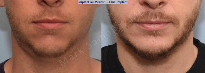 Before & After Augmentation du menton / Chin Augmentation Case 135 View #2 View in Montreal, QC