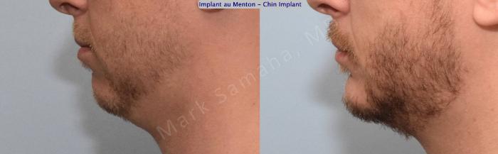 Before & After Augmentation du menton / Chin Augmentation Case 135 View #3 View in Montreal, QC