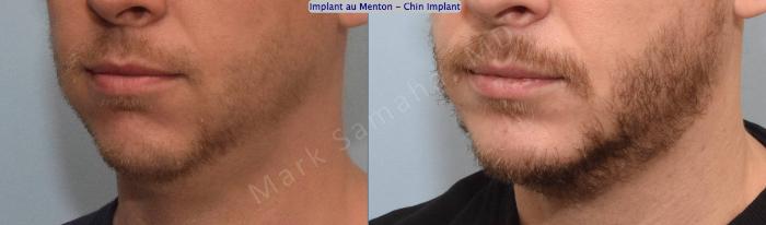 Before & After Augmentation du menton / Chin Augmentation Case 135 View #4 View in Montreal, QC