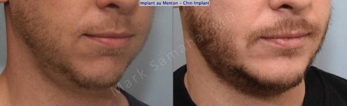 Before & After Augmentation du menton / Chin Augmentation Case 135 View #5 View in Montreal, QC