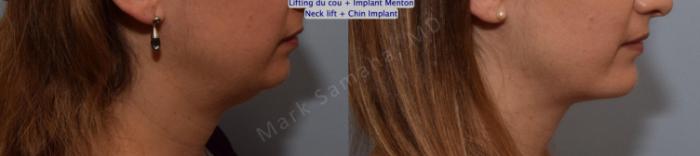 Before & After Augmentation du menton / Chin Augmentation Case 147 Right Side View in Montreal, QC
