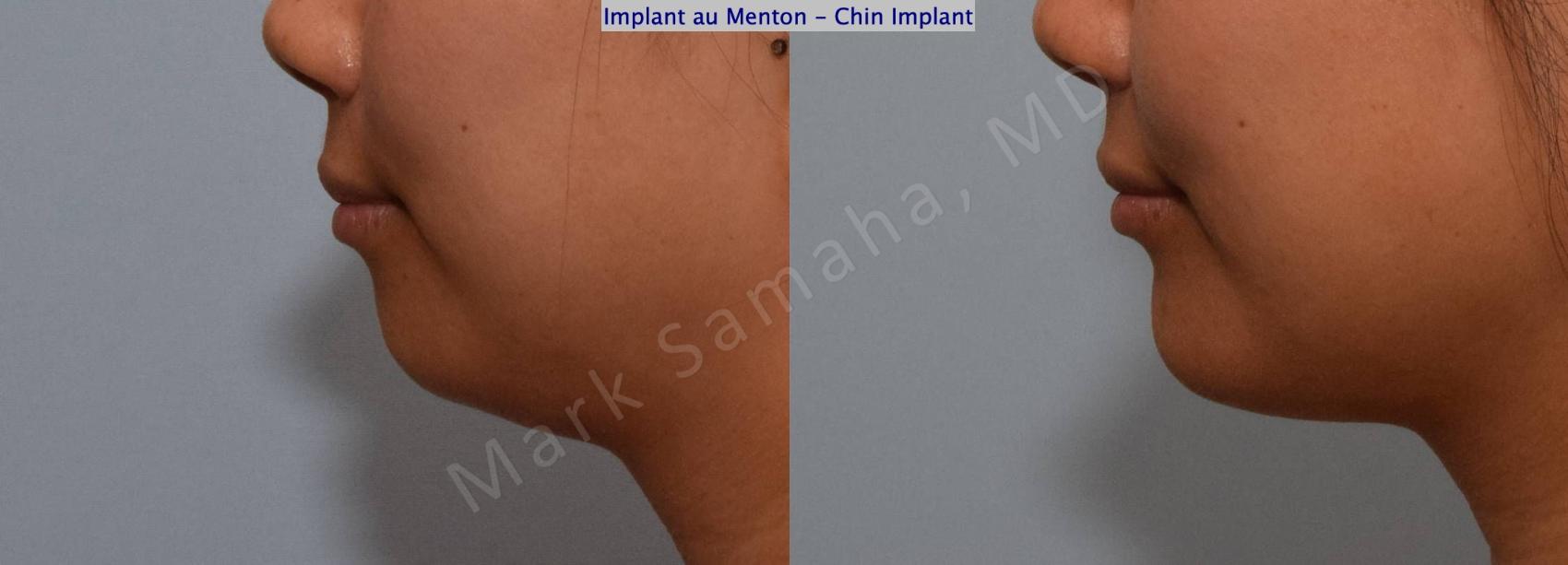 Before & After Augmentation du menton / Chin Augmentation Case 148 Left Side View in Montreal, QC