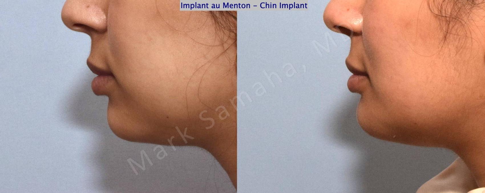 Before & After Augmentation du menton / Chin Augmentation Case 149 Left Side View in Mount Royal, QC