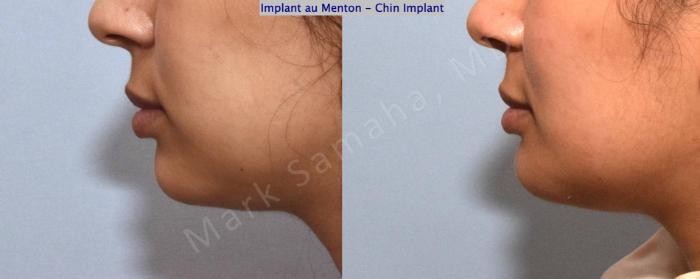 Before & After Augmentation du menton / Chin Augmentation Case 149 Left Side View in Montreal, QC