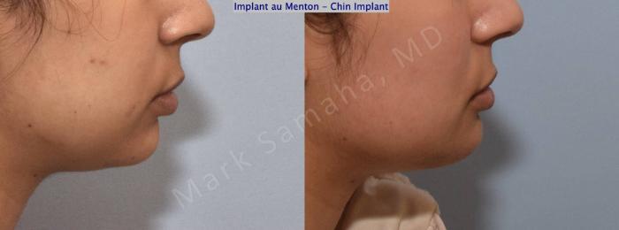 Before & After Augmentation du menton / Chin Augmentation Case 149 Right Side View in Montreal, QC