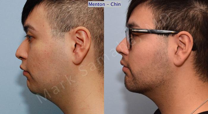 Before & After Augmentation du menton / Chin Augmentation Case 9 View #1 View in Montreal, QC