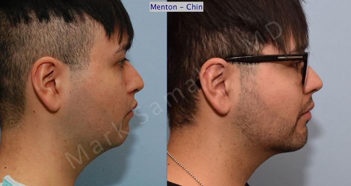 Before & After Augmentation du menton / Chin Augmentation Case 9 View #2 View in Montreal, QC