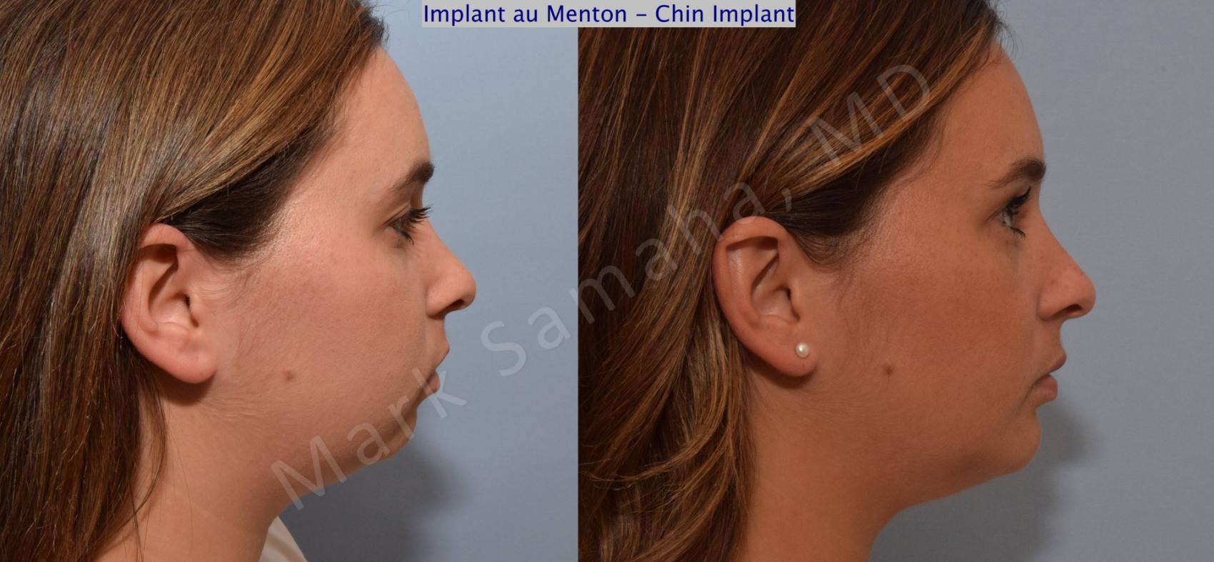 Before & After Augmentation du menton / Chin Augmentation Case 98 View #1 View in Montreal, QC
