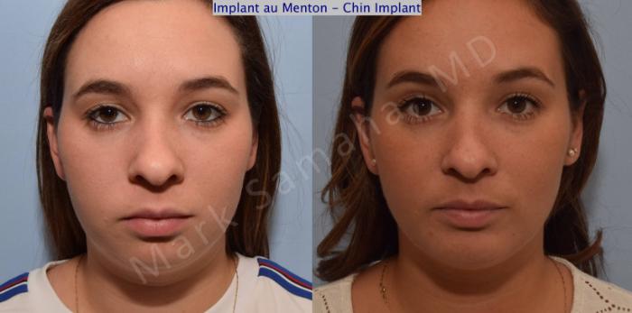Before & After Augmentation du menton / Chin Augmentation Case 98 View #2 View in Montreal, QC