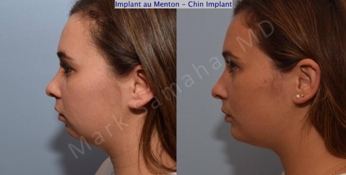 Before & After Augmentation du menton / Chin Augmentation Case 98 View #3 View in Montreal, QC