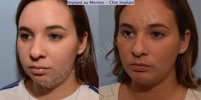 Before & After Augmentation du menton / Chin Augmentation Case 98 View #4 View in Montreal, QC