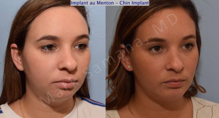 Before & After Augmentation du menton / Chin Augmentation Case 98 View #5 View in Montreal, QC
