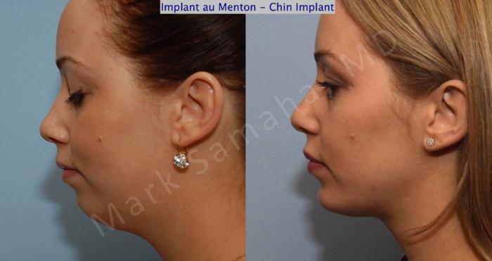Before & After Augmentation du menton / Chin Augmentation Case 99 View #1 View in Montreal, QC