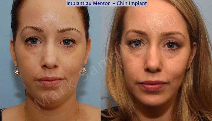 Before & After Augmentation du menton / Chin Augmentation Case 99 View #2 View in Montreal, QC