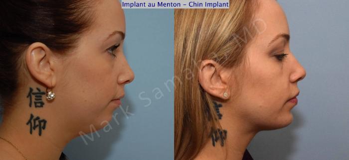 Before & After Augmentation du menton / Chin Augmentation Case 99 View #3 View in Montreal, QC