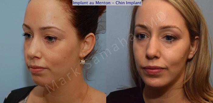 Before & After Augmentation du menton / Chin Augmentation Case 99 View #4 View in Montreal, QC