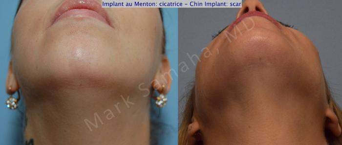 Before & After Augmentation du menton / Chin Augmentation Case 99 View #6 View in Montreal, QC