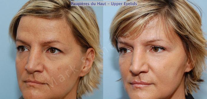 Before & After Blépharoplastie / Blepharoplasty Case 1 View #2 View in Montreal, QC