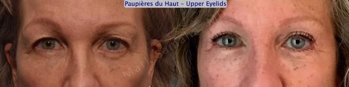 Before & After Blépharoplastie / Blepharoplasty Case 144 Front View in Mount Royal, QC