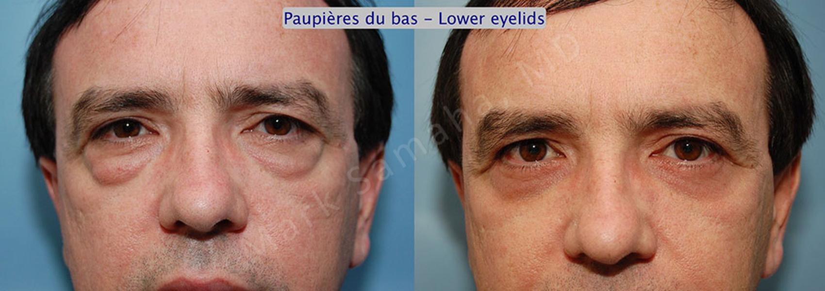 Before & After Blépharoplastie / Blepharoplasty Case 2 View #1 View in Montreal, QC
