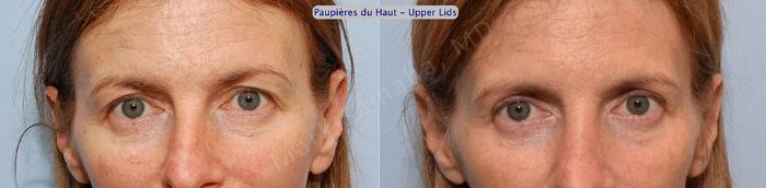 Before & After Blépharoplastie / Blepharoplasty Case 3 View #1 View in Montreal, QC