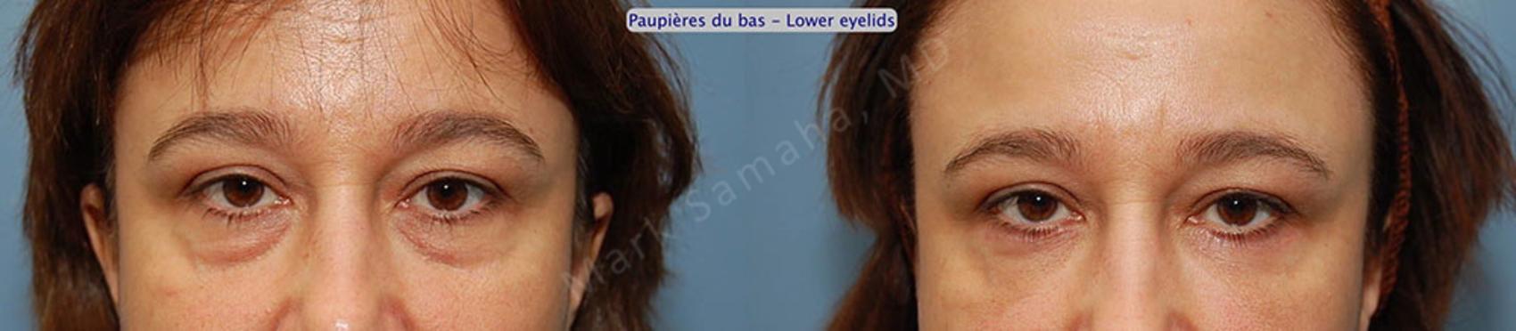 Before & After Blépharoplastie / Blepharoplasty Case 4 View #1 View in Montreal, QC