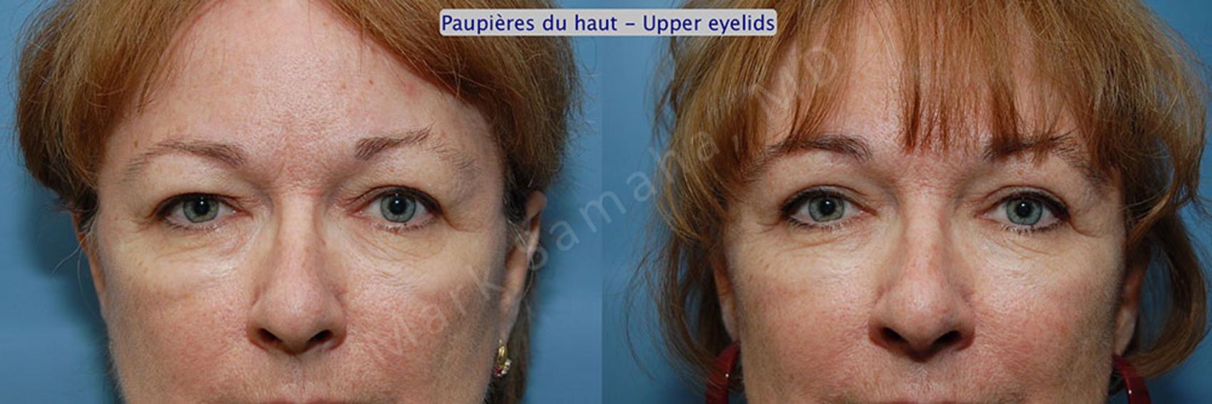 Before & After Blépharoplastie / Blepharoplasty Case 5 View #1 View in Montreal, QC