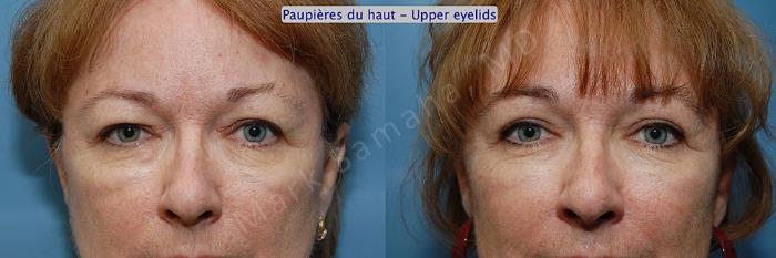 Before & After Blépharoplastie / Blepharoplasty Case 5 View #1 View in Mount Royal, QC