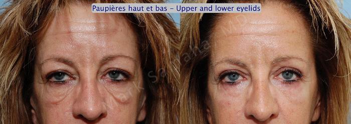 Before & After Blépharoplastie / Blepharoplasty Case 6 View #1 View in Montreal, QC