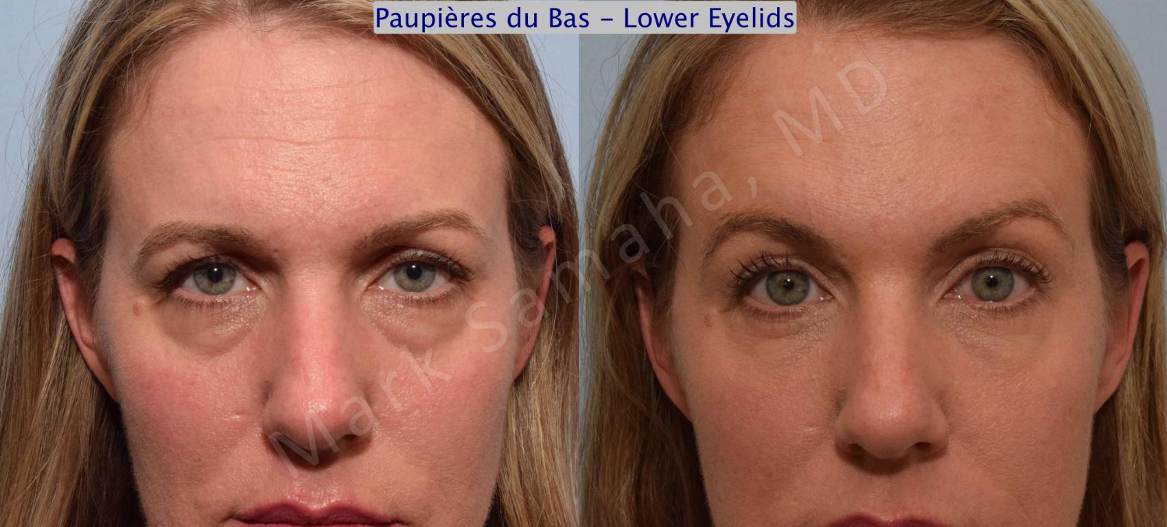 Before & After Blépharoplastie / Blepharoplasty Case 61 View #1 View in Mount Royal, QC