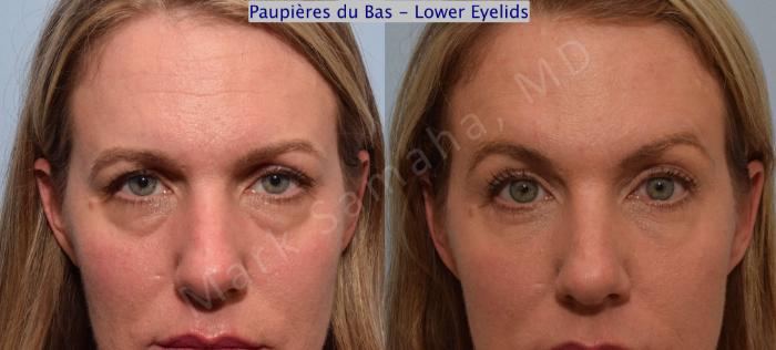 Before & After Blépharoplastie / Blepharoplasty Case 61 View #1 View in Mount Royal, QC