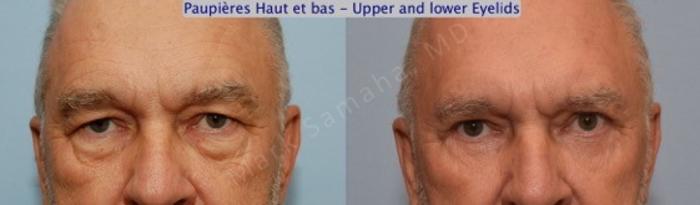 Before & After Blépharoplastie / Blepharoplasty Case 62 View #1 View in Montreal, QC