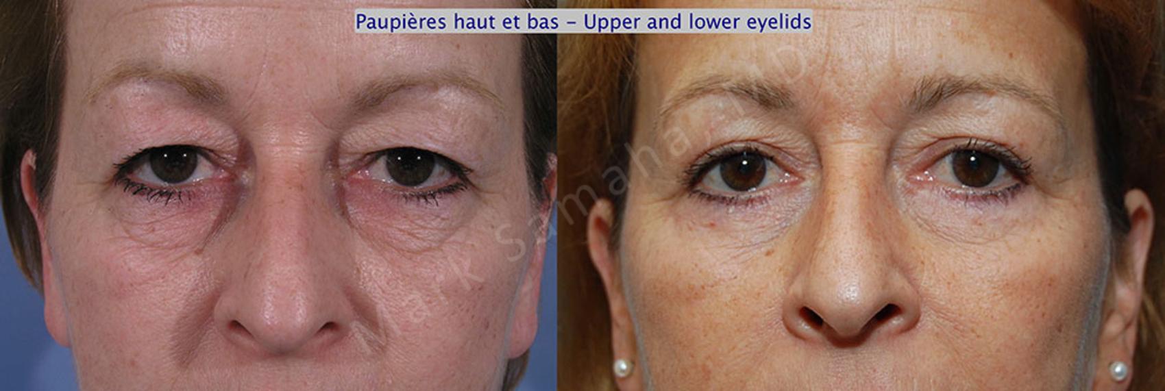 Before & After Blépharoplastie / Blepharoplasty Case 7 View #1 View in Montreal, QC