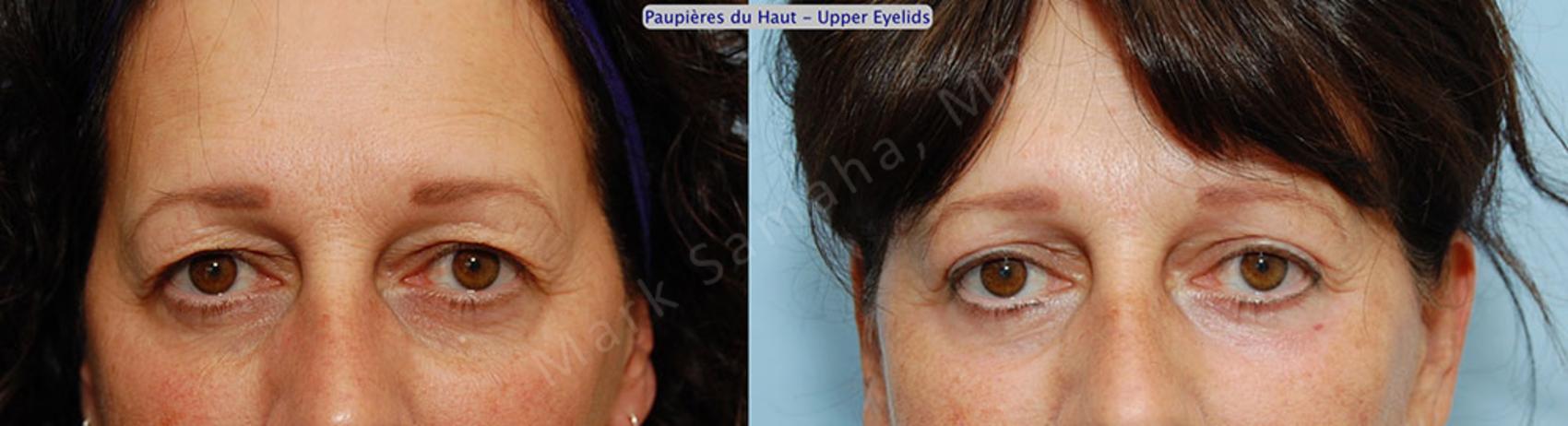 Before & After Blépharoplastie / Blepharoplasty Case 8 View #1 View in Montreal, QC