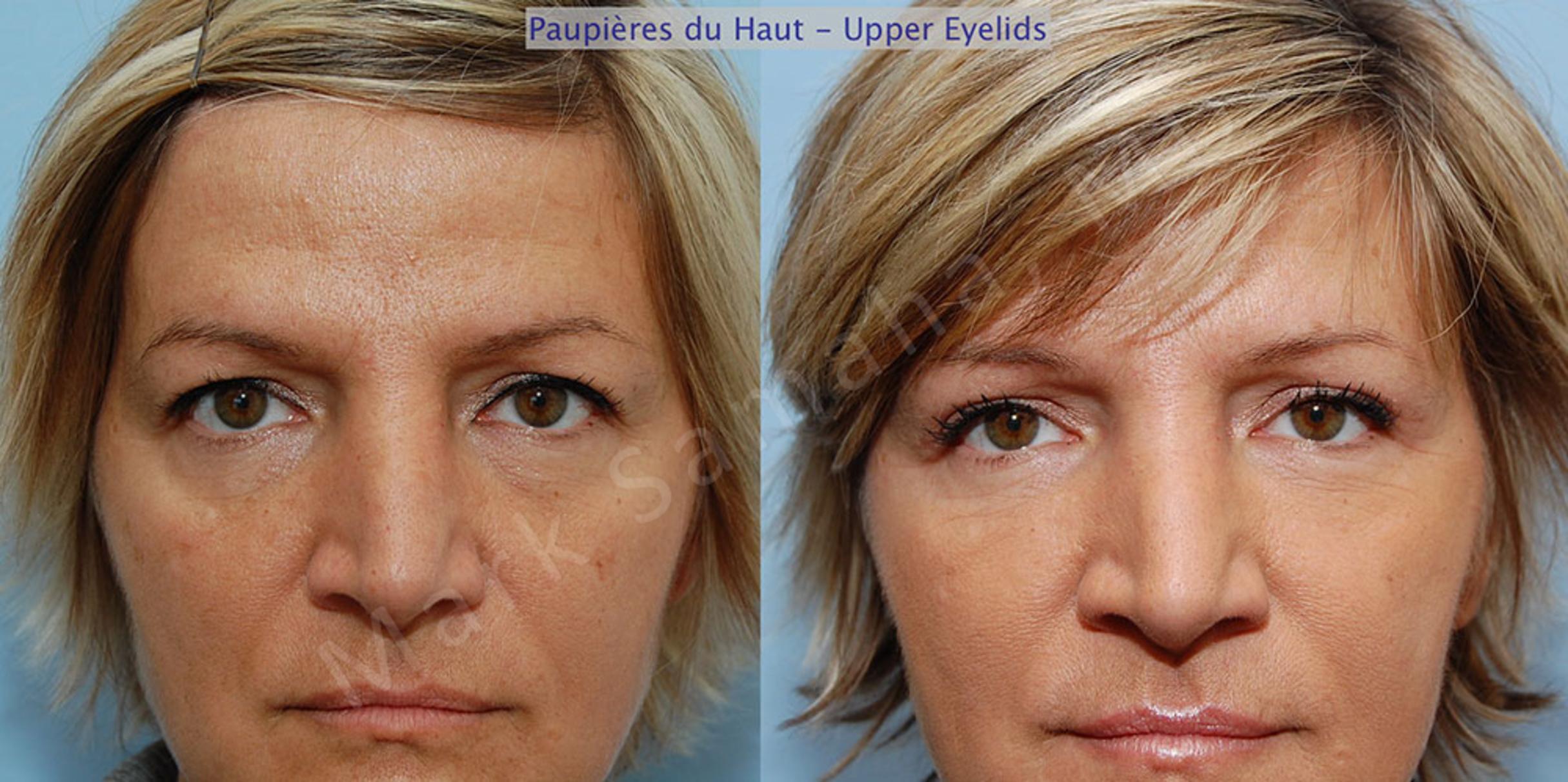 Before & After Blepharoplasty / Blépharoplastie Case 1 View #1 View in Mount Royal, QC