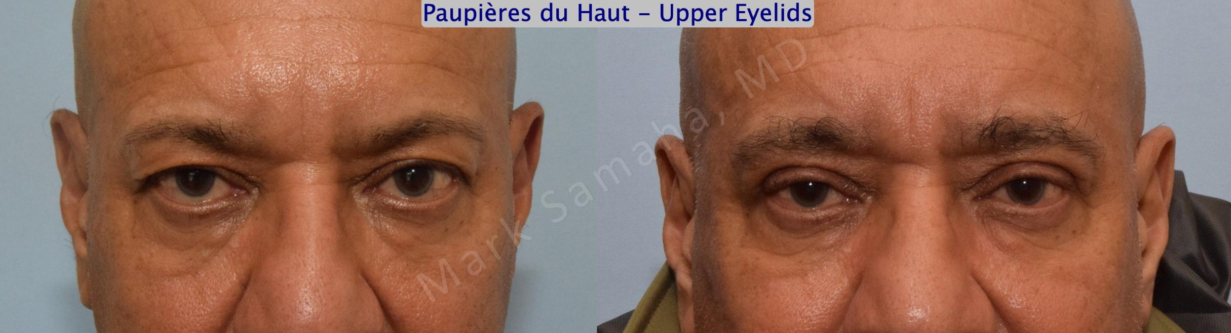 Before & After Blepharoplasty / Blépharoplastie Case 143 Front View in Mount Royal, QC
