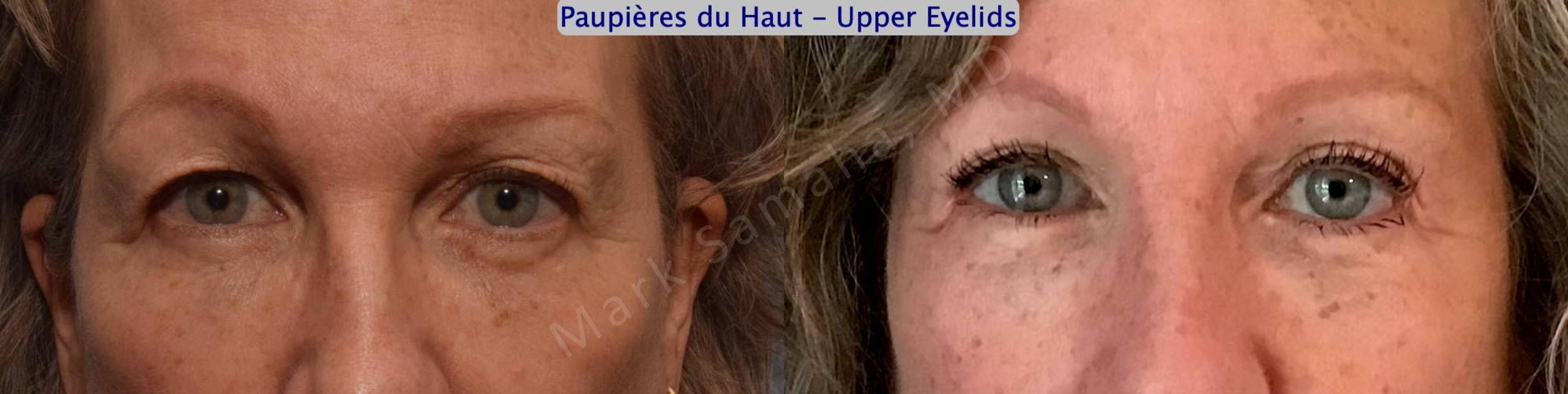Before & After Blepharoplasty / Blépharoplastie Case 144 Front View in Mount Royal, QC