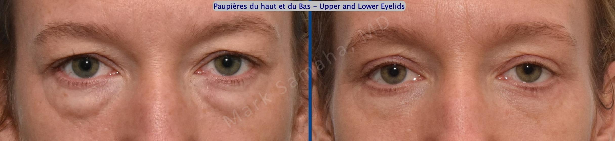 Before & After Blépharoplastie / Blepharoplasty Case 203 Front View in Mount Royal, QC