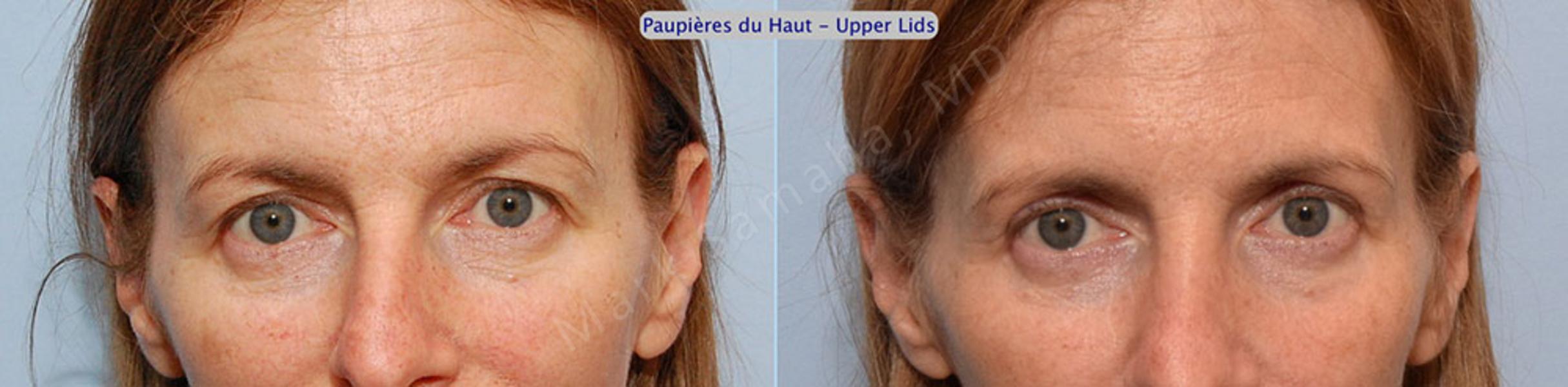 Before & After Blepharoplasty / Blépharoplastie Case 3 View #1 View in Mount Royal, QC