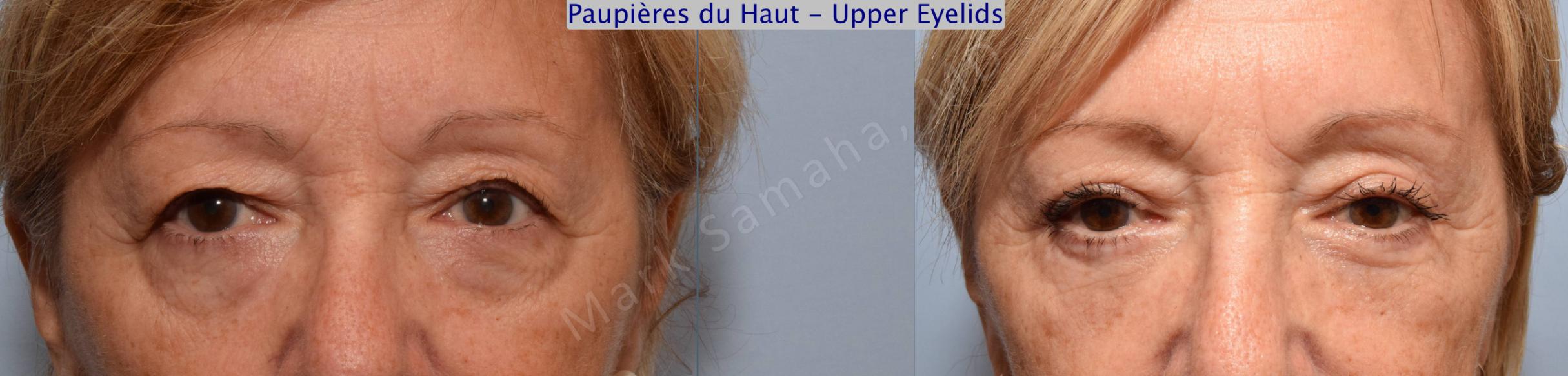 Before & After Blepharoplasty / Blépharoplastie Case 59 View #1 View in Mount Royal, QC