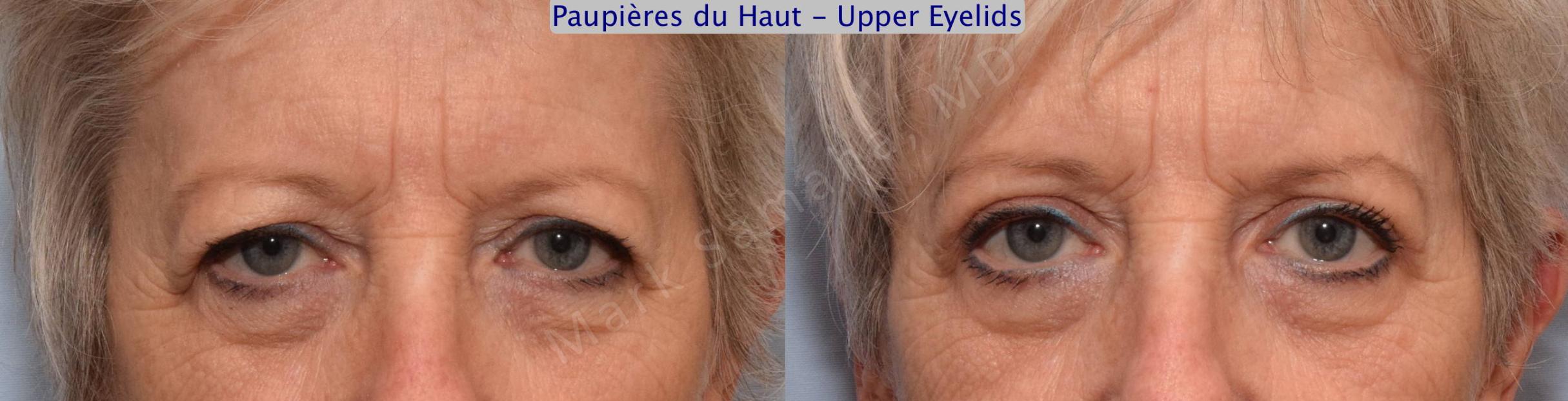 Before & After Blepharoplasty / Blépharoplastie Case 60 View #1 View in Mount Royal, QC