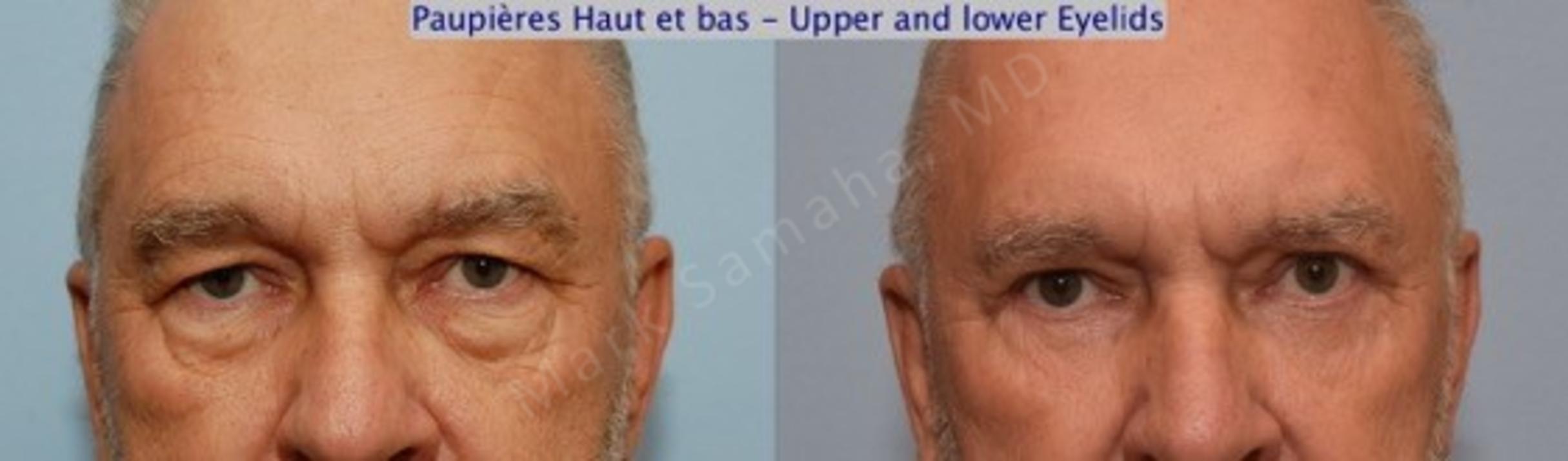 Before & After Blepharoplasty / Blépharoplastie Case 62 View #1 View in Mount Royal, QC